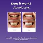 SmileyStrips - Purple Teeth Whitening Strips