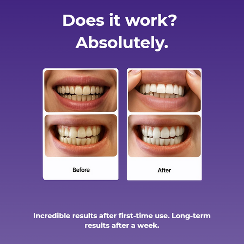 SmileyStrips - Purple Teeth Whitening Strips